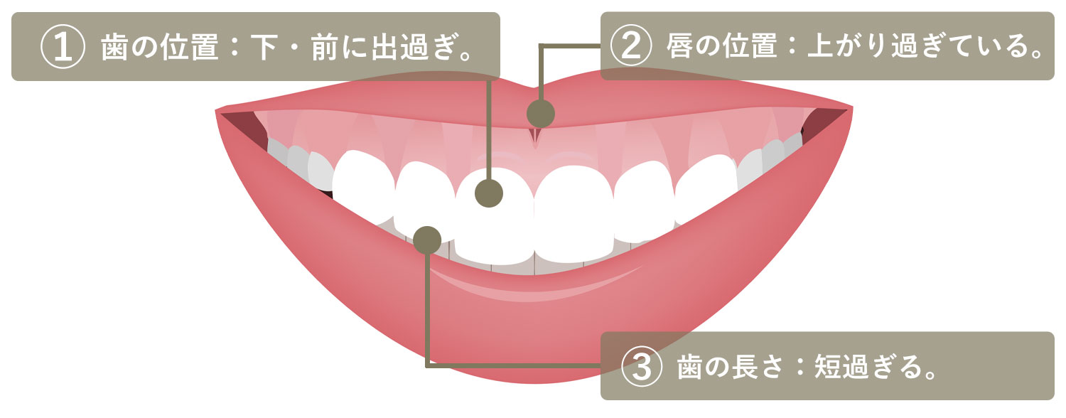 ガミースマイル